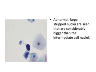 • Abnormal, large
stripped nuclei are seen
that are considerably
bigger than the
intermediate cell nuclei.
 