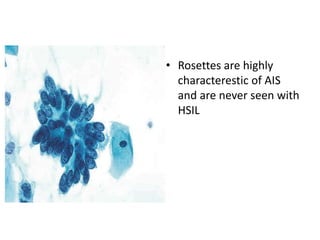 • Rosettes are highly
characterestic of AIS
and are never seen with
HSIL
 