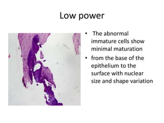 Low power
• The abnormal
immature cells show
minimal maturation
• from the base of the
epithelium to the
surface with nuclear
size and shape variation
 