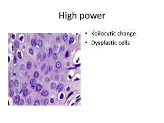 High power
• Koilocytic change
• Dysplastic cells
 
