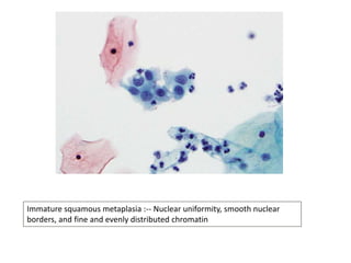 Immature squamous metaplasia :-- Nuclear uniformity, smooth nuclear
borders, and fine and evenly distributed chromatin
 