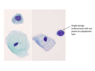 Single benign
endocervical cells are
prone to cytoplasmic
lysis
 