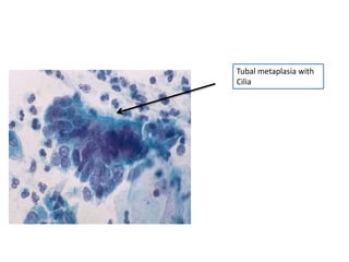 Tubal metaplasia with
Cilia
 