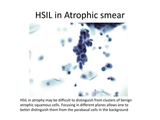 HSIL in Atrophic smear
HSIL in atrophy may be difficult to distinguish from clusters of benign
atrophic squamous cells. Focusing in different planes allows one to
better distinguish them from the parabasal cells in the background
 