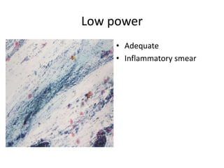 Low power
• Adequate
• Inflammatory smear
 