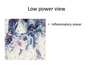 Low power view
• Inflammatory smear
 