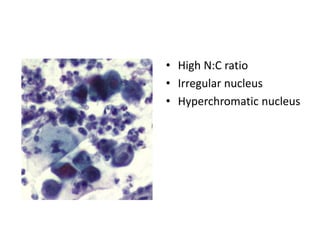 • High N:C ratio
• Irregular nucleus
• Hyperchromatic nucleus
 