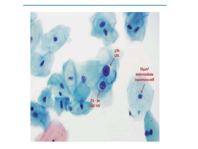 PAP SMEAR examination in cytology 23.pptx