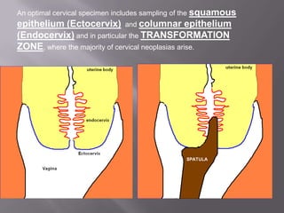 An optimal cervical specimen includes sampling of the squamous
epithelium (Ectocervix) and columnar epithelium
(Endocervix) and in particular the TRANSFORMATION
ZONE, where the majority of cervical neoplasias arise.
 