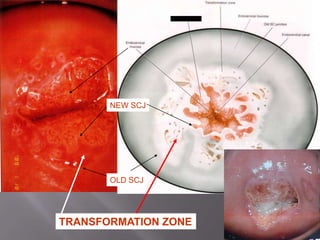 OLD SCJ
NEW SCJ
TRANSFORMATION ZONE
 