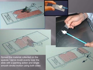 Spread the material collected on the
spatula / cervix brush evenly over the
slide with a painting action and single
smooth stroke motion using both sides
 