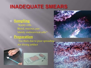  Sampling
Scanty cells
Blood, mucous, pus
Mainly endocervical cells *
 Preparation
Too thick due to poor spreading
Air drying artifact
 