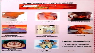 Paptic ulcer.pptx