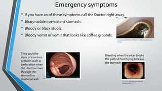 Emergency symptoms
• If you have an of these symptoms call the Doctor right away.
• Sharp sudden persistent stomach.
• Bloody or black stools.
• Bloody vomit or vomit that looks like coffee grounds.
They could be
signs of a serious
problem such as
perforation when
the ulcer burrows
through the
stomach or
duodenal wall.
Bleeding when the ulcer blocks
the path of food trying to leave
the stomach.
This Photo by Unknown Author is licensed under CC BY-
SA-NC
This Photo by Unknown Author is licensed
under CC BY
This Photo by Unknown Author is
licensed under CC BY
 