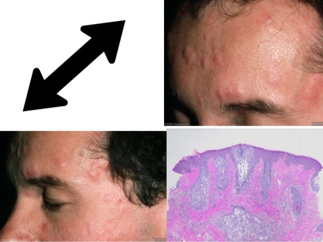 differentials of papules on face