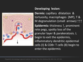 Developing lesion:
Dermis: capillary dilatation &
tortuosity, macrophages (MP), T &
M degranulation (small arrows) ↑↑↑
Epidermis: thickness ↑, prominent
rete pegs, spotty loss of the
granular layer & parakeratosis. L
begin to exit the epidermis,
inflammatory dendritic epidermal
cells (I) & CD8+ T cells (8) begin to
enter the epidermis
Fitzpatrick's dermatology in general medicine. Edisi ke-8. New York: McGraw-Hill; 2012. hlm. 197-232.
 