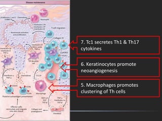 6. Keratinocytes promote
neoangiogenesis
7. Tc1 secretes Th1 & Th17
cytokines
5. Macrophages promotes
clustering of Th cells
 