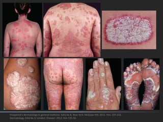 Fitzpatrick's dermatology in general medicine. Edisi ke-8. New York: McGraw-Hill; 2012. hlm. 197-232.
Dermatology. Edisi ke-3. London: Elsevier; 2012. hlm 135-56.
 