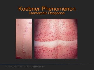 Koebner Phenomenon
Dermatology. Edisi ke-3. London: Elsevier; 2012. hlm 135-56.
Isomorphic Response
 