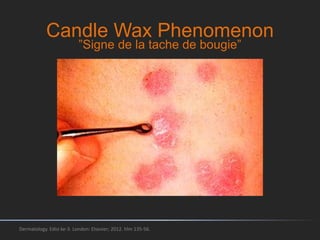 Candle Wax Phenomenon
Dermatology. Edisi ke-3. London: Elsevier; 2012. hlm 135-56.
”Signe de la tache de bougie”
 