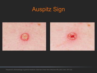 Auspitz Sign
Fitzpatrick's dermatology in general medicine. Edisi ke-8. New York: McGraw-Hill; 2012. hlm. 197-232.
 