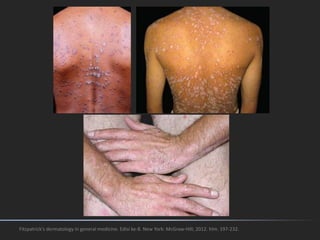 Fitzpatrick's dermatology in general medicine. Edisi ke-8. New York: McGraw-Hill; 2012. hlm. 197-232.
 