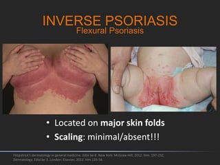 INVERSE PSORIASIS
Fitzpatrick's dermatology in general medicine. Edisi ke-8. New York: McGraw-Hill; 2012. hlm. 197-232.
Dermatology. Edisi ke-3. London: Elsevier; 2012. hlm 135-56.
Flexural Psoriasis
• Located on major skin folds
• Scaling: minimal/absent!!!
 