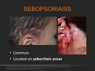 SEBOPSORIASIS
Fitzpatrick's dermatology in general medicine. Edisi ke-8. New York: McGraw-Hill; 2012. hlm. 197-232.
Dermatology. Edisi ke-3. London: Elsevier; 2012. hlm 135-56.
• Common
• Located on seborrheic areas
 