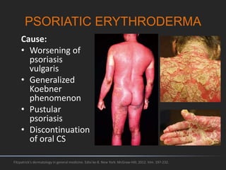 PSORIATIC ERYTHRODERMA
Fitzpatrick's dermatology in general medicine. Edisi ke-8. New York: McGraw-Hill; 2012. hlm. 197-232.
Cause:
• Worsening of
psoriasis
vulgaris
• Generalized
Koebner
phenomenon
• Pustular
psoriasis
• Discontinuation
of oral CS
 