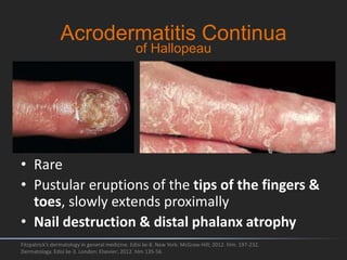 Acrodermatitis Continua
Fitzpatrick's dermatology in general medicine. Edisi ke-8. New York: McGraw-Hill; 2012. hlm. 197-232.
Dermatology. Edisi ke-3. London: Elsevier; 2012. hlm 135-56.
• Rare
• Pustular eruptions of the tips of the fingers &
toes, slowly extends proximally
• Nail destruction & distal phalanx atrophy
of Hallopeau
 
