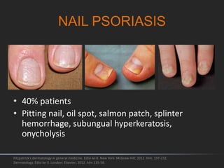 NAIL PSORIASIS
Fitzpatrick's dermatology in general medicine. Edisi ke-8. New York: McGraw-Hill; 2012. hlm. 197-232.
Dermatology. Edisi ke-3. London: Elsevier; 2012. hlm 135-56.
• 40% patients
• Pitting nail, oil spot, salmon patch, splinter
hemorrhage, subungual hyperkeratosis,
onycholysis
 