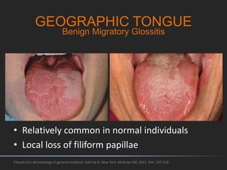 GEOGRAPHIC TONGUE
Fitzpatrick's dermatology in general medicine. Edisi ke-8. New York: McGraw-Hill; 2012. hlm. 197-232.
• Relatively common in normal individuals
• Local loss of filiform papillae
Benign Migratory Glossitis
 