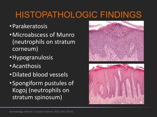 HISTOPATHOLOGIC FINDINGS
•Parakeratosis
•Microabscess of Munro
(neutrophils on stratum
corneum)
•Hypogranulosis
•Acanthosis
•Dilated blood vessels
•Spongiform pustules of
Kogoj (neutrophils on
stratum spinosum)
Dermatology. Edisi ke-3. London: Elsevier; 2012. hlm 135-56.
 