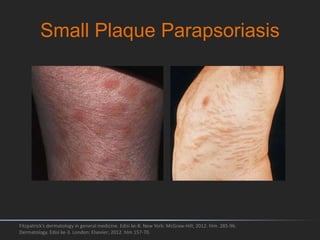 Small Plaque Parapsoriasis
Fitzpatrick's dermatology in general medicine. Edisi ke-8. New York: McGraw-Hill; 2012. hlm. 285-96.
Dermatology. Edisi ke-3. London: Elsevier; 2012. hlm 157-70.
 