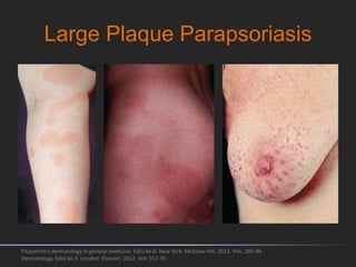 Large Plaque Parapsoriasis
Fitzpatrick's dermatology in general medicine. Edisi ke-8. New York: McGraw-Hill; 2012. hlm. 285-96.
Dermatology. Edisi ke-3. London: Elsevier; 2012. hlm 157-70.
 