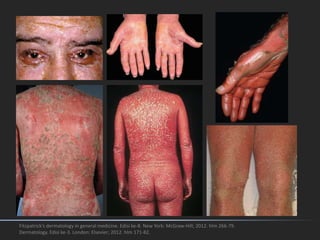 Fitzpatrick's dermatology in general medicine. Edisi ke-8. New York: McGraw-Hill; 2012. hlm 266-79.
Dermatology. Edisi ke-3. London: Elsevier; 2012. hlm 171-82.
 