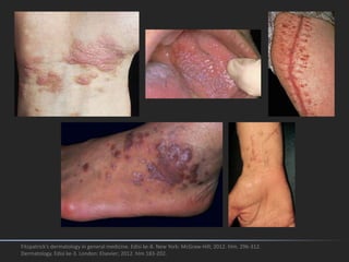 Fitzpatrick's dermatology in general medicine. Edisi ke-8. New York: McGraw-Hill; 2012. hlm. 296-312.
Dermatology. Edisi ke-3. London: Elsevier; 2012. hlm 183-202.
 