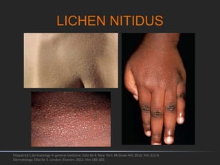 LICHEN NITIDUS
Fitzpatrick's dermatology in general medicine. Edisi ke-8. New York: McGraw-Hill; 2012. hlm 312-6.
Dermatology. Edisi ke-3. London: Elsevier; 2012. hlm 183-202.
 