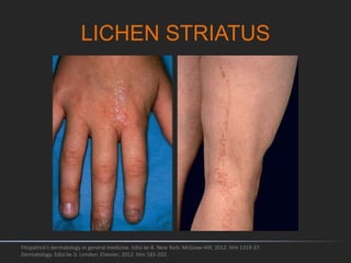 LICHEN STRIATUS
Fitzpatrick's dermatology in general medicine. Edisi ke-8. New York: McGraw-Hill; 2012. hlm 1319-37.
Dermatology. Edisi ke-3. London: Elsevier; 2012. hlm 183-202.
 