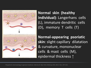 Fitzpatrick's dermatology in general medicine. Edisi ke-8. New York: McGraw-Hill; 2012. hlm. 197-232.
Normal skin (healthy
individual): Langerhans cells
(L), immature dendritic cells
(D), memory T cells (T)
Normal-appearing psoriatic
skin: slight capillary dilatation
& curvature, mononuclear
cells & mast cells (M),
epidermal thickness ↑
 