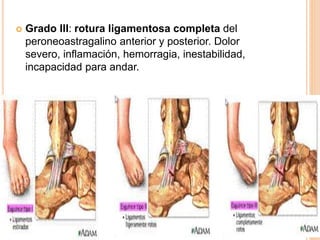  Grado III: rotura ligamentosa completa del
peroneoastragalino anterior y posterior. Dolor
severo, inflamación, hemorragia, inestabilidad,
incapacidad para andar.
 