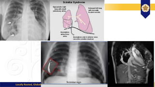 papvd partial anomalous pulmonary vein drainage.pptx