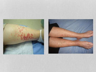 Paraneoplastic Leg Rash Para neoplastic (malignant) syndromes | PPTX