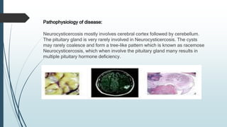 Pathophysiology of disease:
Neurocysticercosis mostly involves cerebral cortex followed by cerebellum.
The pituitary gland is very rarely involved in Neurocysticercosis. The cysts
may rarely coalesce and form a tree-like pattern which is known as racemose
Neurocysticercosis, which when involve the pituitary gland many results in
multiple pituitary hormone deficiency.
 