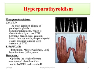 Hyperparathyroidism
Hyperparathyroidism:
CAUSES:
The most common disease of
parathyroid glands is
hyperparathyroidism, which is
characterized by excess PTH
hormone, regardless of calcium
levels. In other words, the parathyroid
glands continue to make large
amounts of PTH .
SYMPTOMS:
Bone pain , Muscle weekness, Long
bone fractures ,kidneystone
Treatment :
Optimize the levels of serum
calcium and phosphate ions
control of PTH and vitamin D
4/5/2018 21Parathyroid Hormones
 