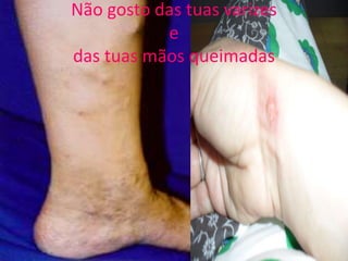 Não gosto das tuas varizesedas tuas mãos queimadas 