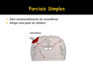  Sem comprometimento da consciência
 Atinge uma parte do cérebro
 