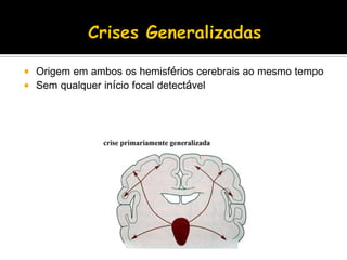  Origem em ambos os hemisférios cerebrais ao mesmo tempo
 Sem qualquer início focal detectável
 