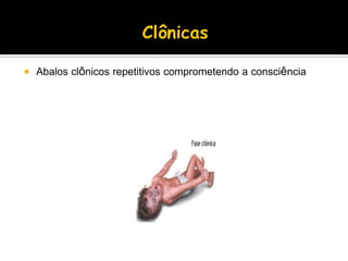  Abalos clônicos repetitivos comprometendo a consciência
 