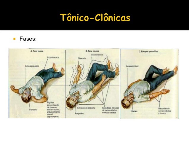 Epilepsia e crise convulsiva